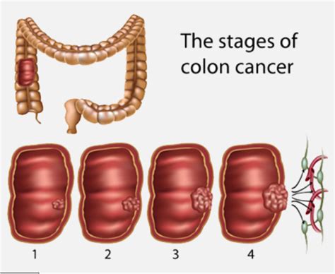 Bowel Cancer Screening Gastrointestinal And Liver Clinic