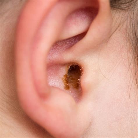 The Biggest Ear Wax Myths Busted Earlab