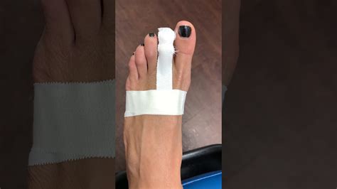 2 Days After Minimally Invasive Toe Shortening Surgery 😁😁😁 Youtube
