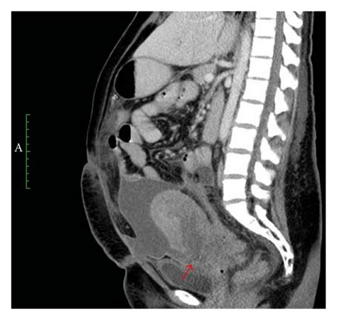 This Sagittal Ct Of The Abdomen Better Demonstrates The Dehiscence Of