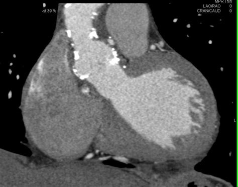 Pseudoaneurysm Aortic Root And Complex Cystic Pelvic Mass In Patient