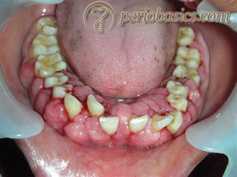 Gingival Enlargement Clinical Periodontology