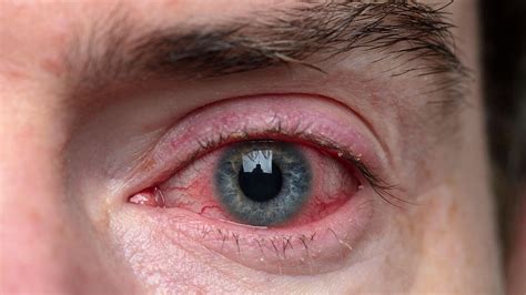 Psoriatic Arthritis And Eye Problems What You Need To Know