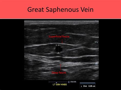Course Of Great Saphenous Vein