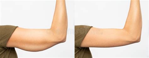 Before And After Excess Skin Removal Under The Arm Stock Image Image Of Treatment Tissue
