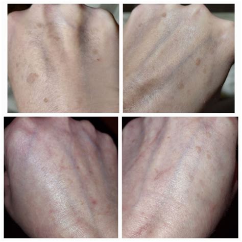 Dark Spots On Hands Ph