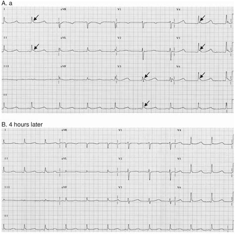 • left ventricular aneurysm o persistent st elevation in leads that look at the affected area following an mi injury is shown on the ecg as an elevated st segment. Acute Coronary Syndrome: ST Elevation Myocardial ...