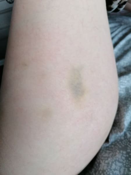 Do These Bruises Look Worrying To You Mumsnet