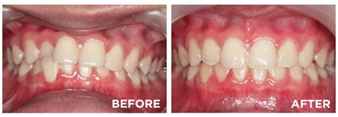 แก้ ฟันซ้อนเก ฟันล่างคร่อมฟันบน แบบไม่เจ็บตัว ทำได้อย่างไร - BFC Dental