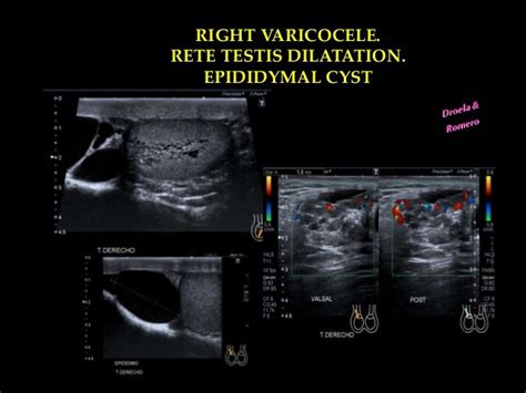 Right Varicocele Ultrasound