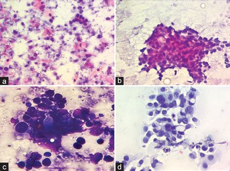 Comparison Of Liquid Based Cytology And Conventional Smears On Lymph