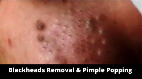 Blackheads Removal Pimple Popping Videos Youtube