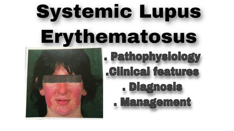 Systemic Lupus Erythematosuspathophysiologydiagnosismanagement