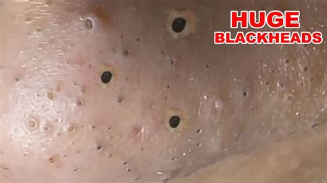 Blackheads Extraction On The Nose Part 1 Youtube