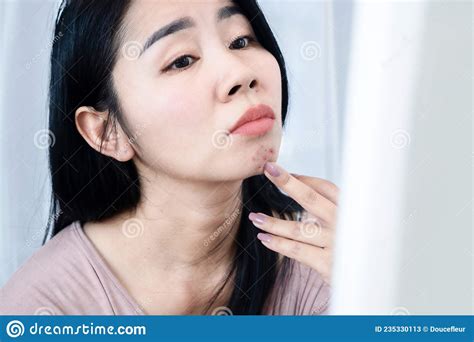 Asian Woman Having Skin Face Problem With Acne And Scars On Chin Stock