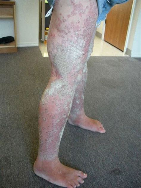 Womans Psoriasis Is So Severe That Her Skin Now Looks Like Tree Bark