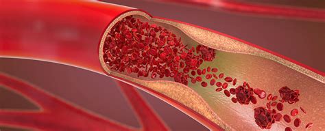 Coronary Artery Disease Cardiovascular Care Englewood Health