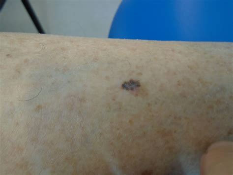 Dermoscopy Melanoma Skin Cancer Can Be Fatal Unless Caught Early But