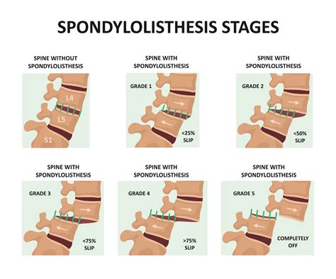 Spondylolisthesis Treatment In Nj Comprehensive Spine Care