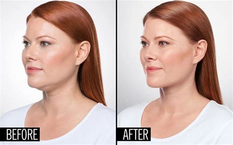 Tacoma Laser Clinic Eliminate Your Double Chin With An Injection