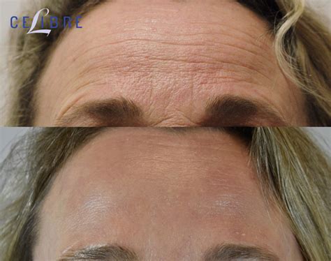 Botox Before And After Pictures Real Results From Real Patients