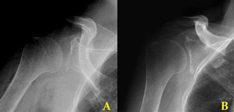 Arthroscopic fixation of iatrogenic glenoid rim fracture ...