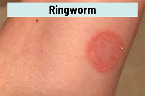 Red Circle On The Skin But Not Itchy Causes And Treatment