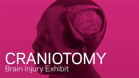 Craniotomy Traumatic Brain Injury Animation Youtube