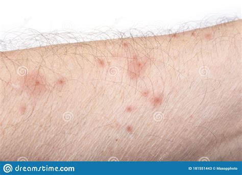 Skin Disease Rash On A Man Arm Stock Image Image Of Blisters Itchy