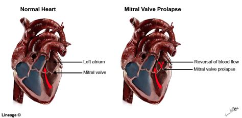 Valvular Disease Cardiovascular Medbullets Step 1