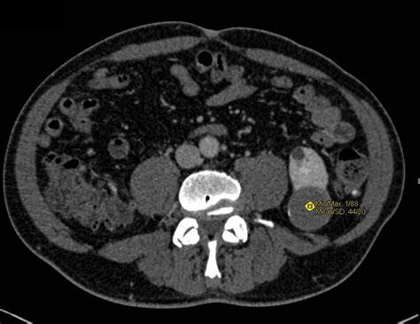 Bosniak 2f Cyst Lower Pole Left Kidney Kidney Case Studies Ctisus