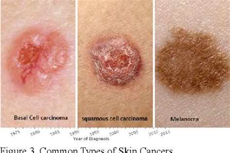 Main Types Of Skin Cancer