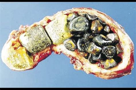 Do you actually need your gallbladder? Gallstones