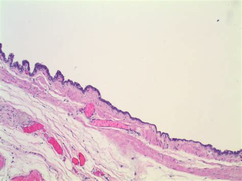 pathology outlines müllerian cyst hattori cyst