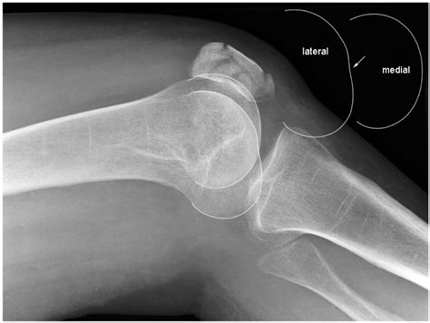 Adult Knee Trauma Radiographic Evaluation Trauma Orthobullets
