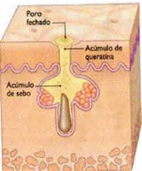 Como acabar com os cravos skincare para cravos. ACNE (CRAVOS E ESPINHAS): Entenda as Causas ⋆ Orientação ...
