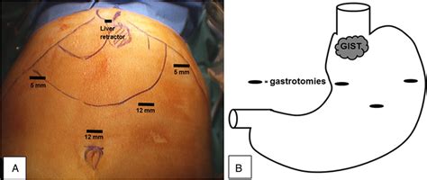 A Instrument Access Points And B Gastrotomy Positions On The