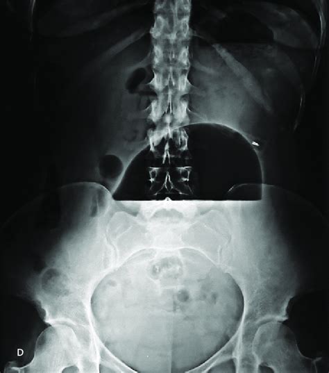 Abdominal X Ray Showing An Enlarged Intragastric Balloon With A Clear