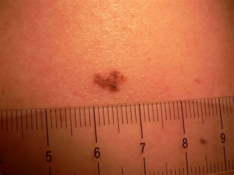 36 Increase In Skin Cancer Cases
