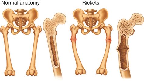 Osteomalacia Diagram