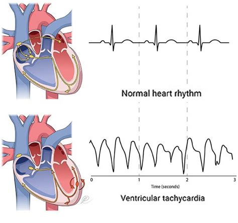 Ventricular Tachycardia Causes Symptoms And Treatment
