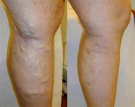 Tips To Prevent And Reduce Or Eliminate Varicose Veins Healthy Logica