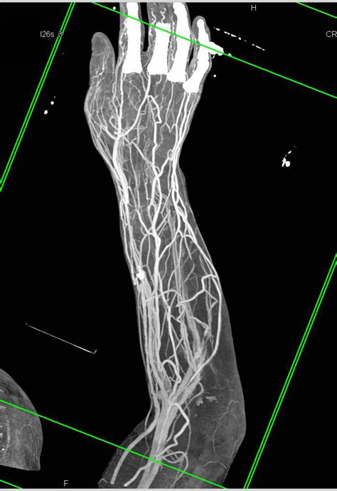 Abscess In Forearm With Cta And 3d Musculoskeletal Case Studies