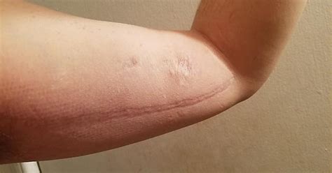 Scar From First Hemodialysis Fistula In My Arm Album On Imgur