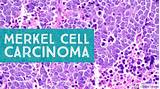 Merkel cell carcinoma of the eyelid is a rare, highly malignant neuroendocrine tumor. Merkel Cell : Trends In Merkel Cell Carcinoma Physician S ...