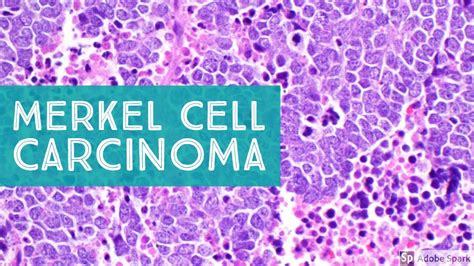 Merkel cell carcinoma of the eyelid is a rare, highly malignant neuroendocrine tumor. Merkel Cell : Trends In Merkel Cell Carcinoma Physician S ...