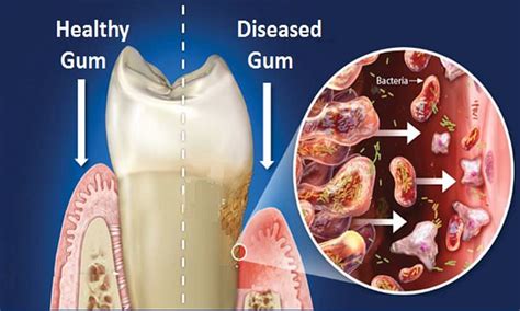 Coronavirus Could Gum Disease Make Infection More Deadly Daily Mail