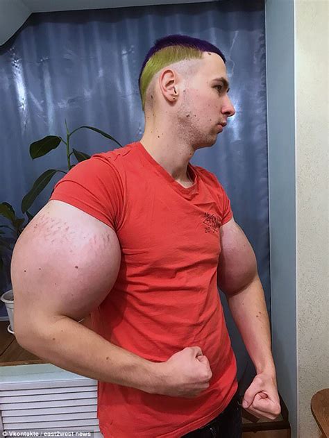 Russian Body Builder Who Injected His Arms With Oil To Make It Big Could Have It Amputated Photos