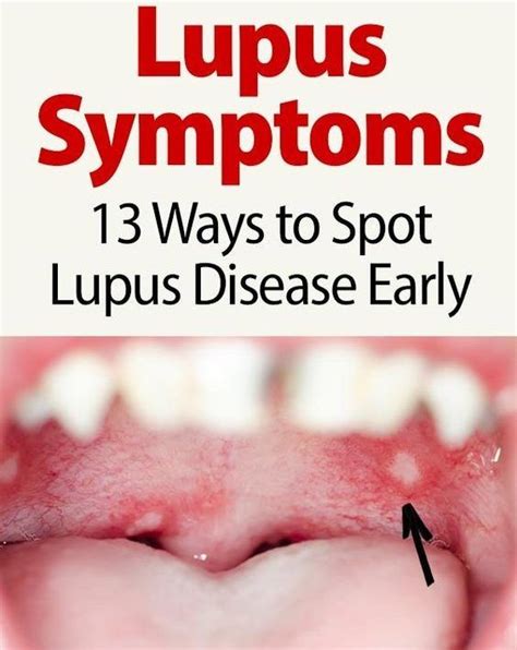13 Warning Signs Of Lupus That May Put You In The Hospital Treat It