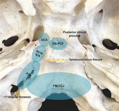 Frontiers Endoscopic Endonasal Surgical Strategy For Skull Base Chordomas Based On Tumor